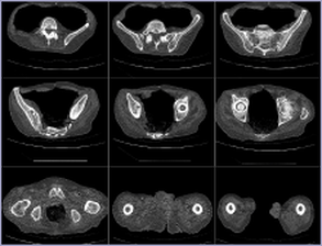 Mako Robot CT scan