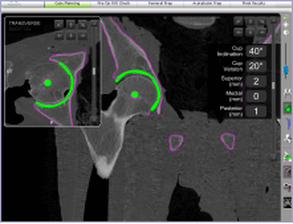 Mako Robot CT scan during surgery